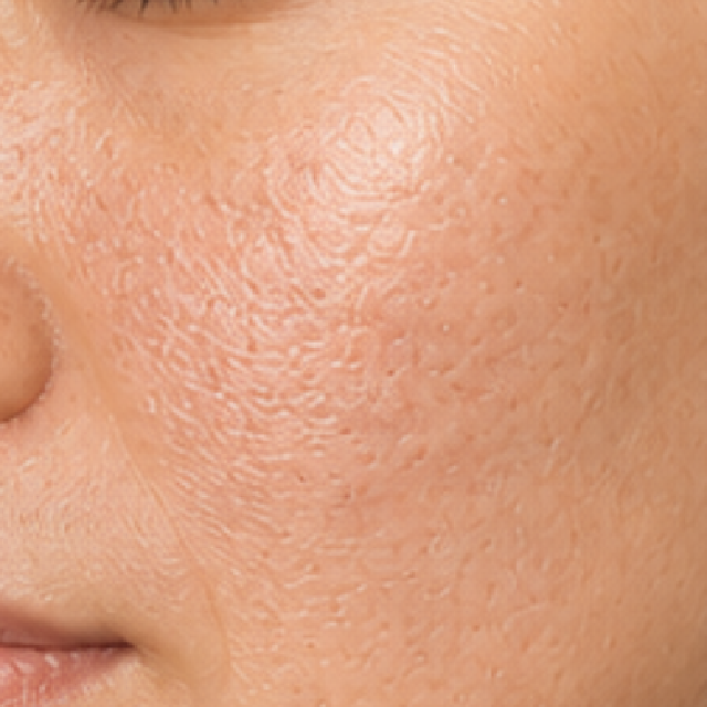 Skin before