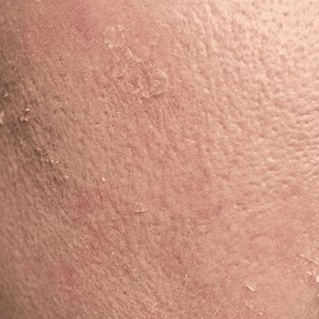 Skin before