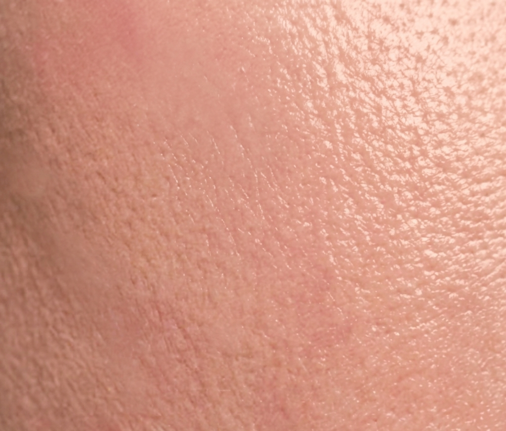 Skin after 14 days